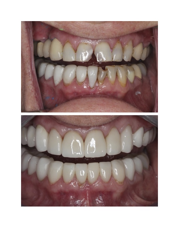 Smile Makeover